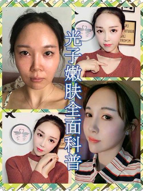光子嫩肤怎么做视频