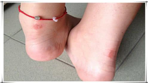 鞋磨脚后跟的小妙招