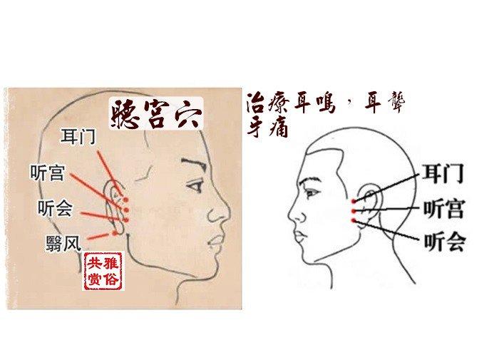 治疗耳鸣小窍门